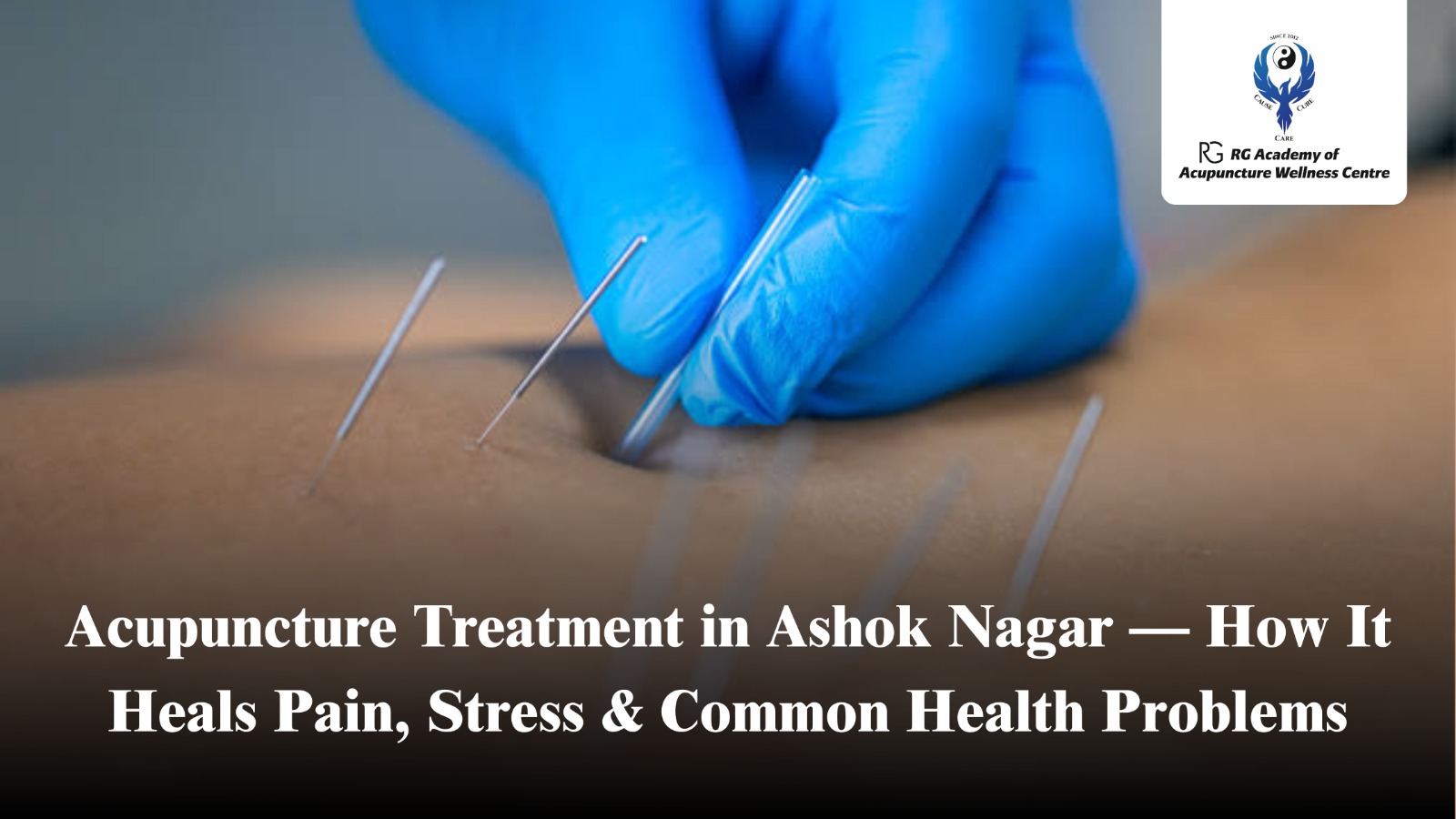 Acupuncture Treatment in Ashok Nagar | Pain & Stress Relief