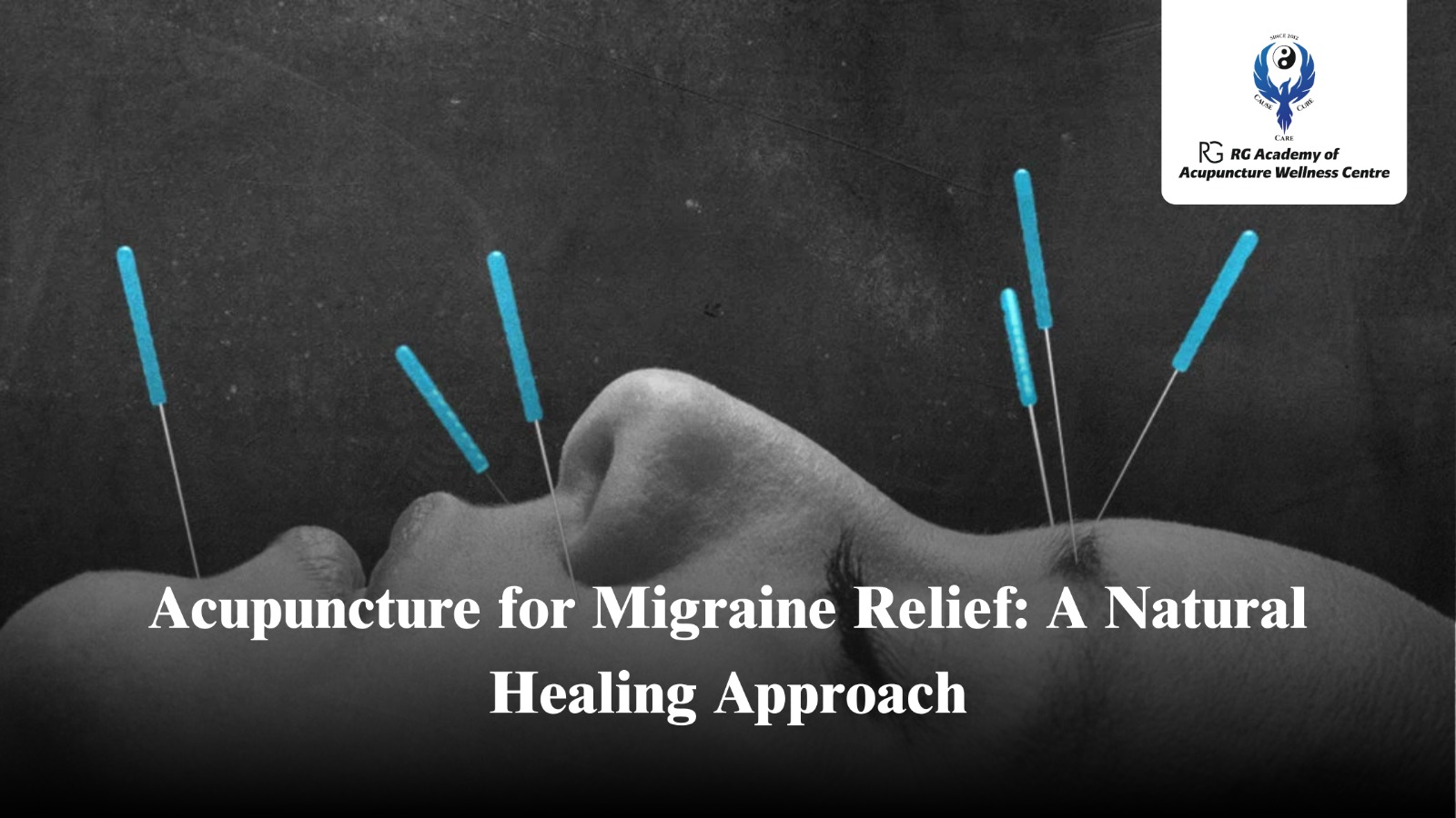 Acupuncture for Migraine Relief | RG Academy Blog
